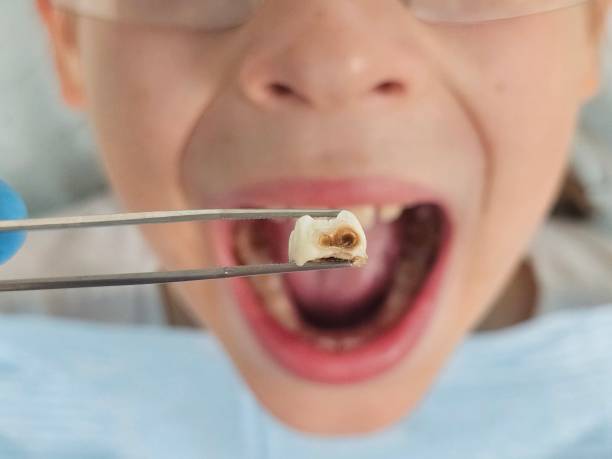 Best Emergency Tooth Extraction in Paradise, CA